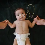 Baby tumour patient with hands held