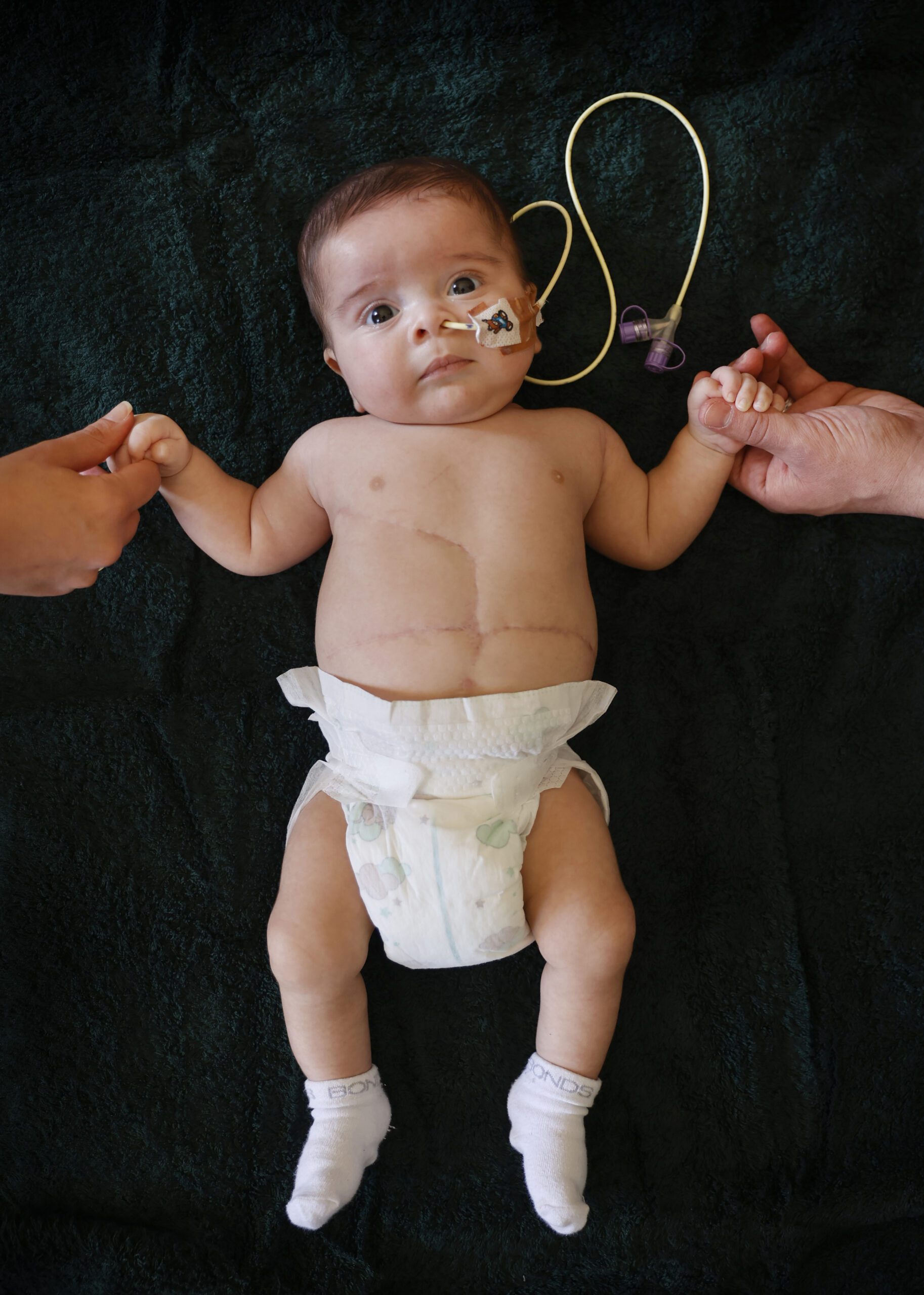 Baby tumour patient with hands held