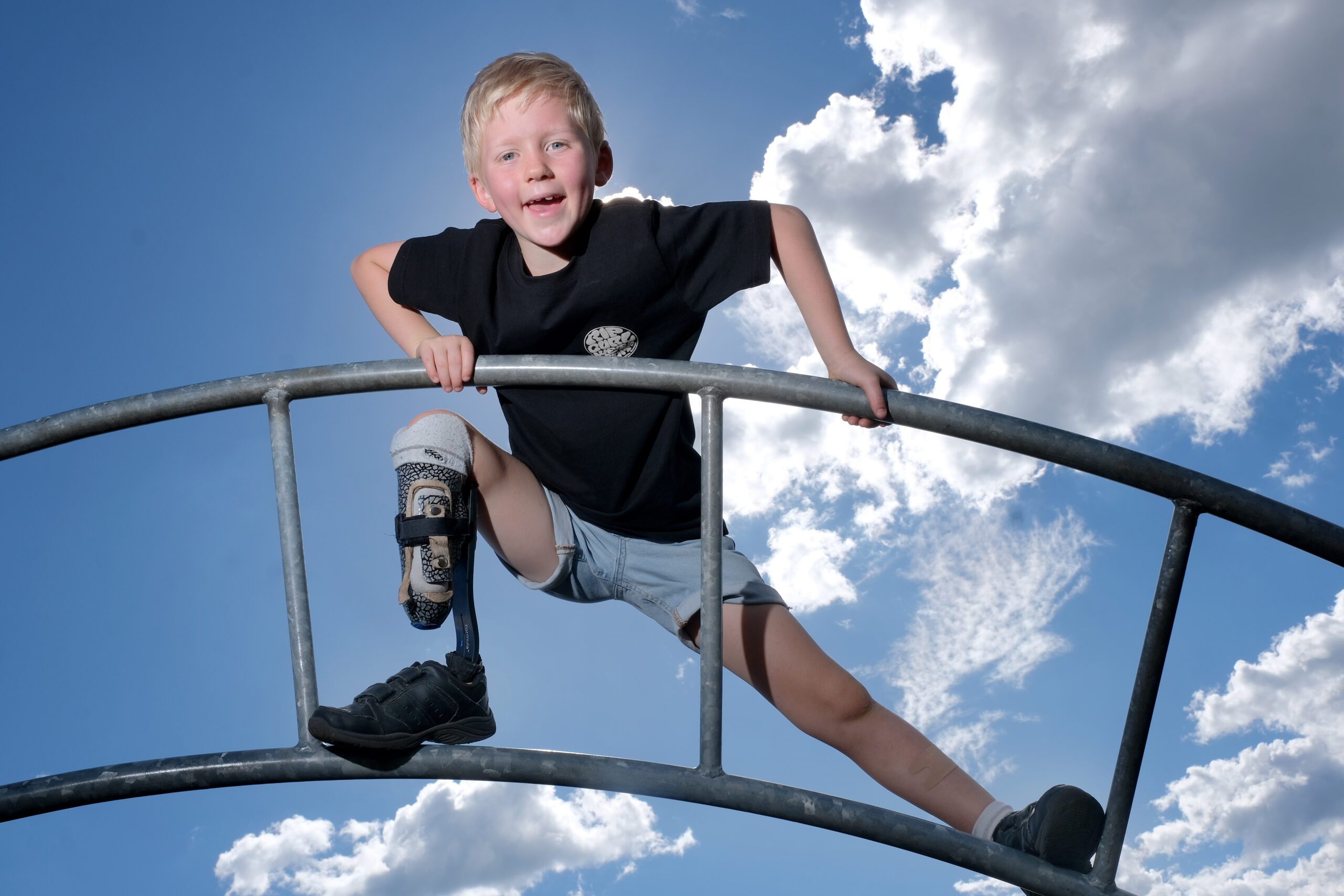 Child on play equipment with a prosthetic leg